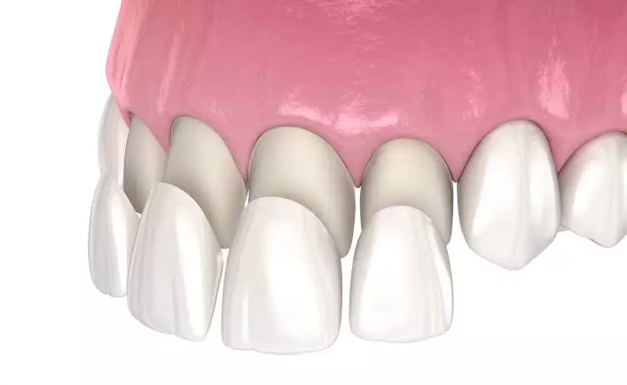 teeth-whitening-thumbnail