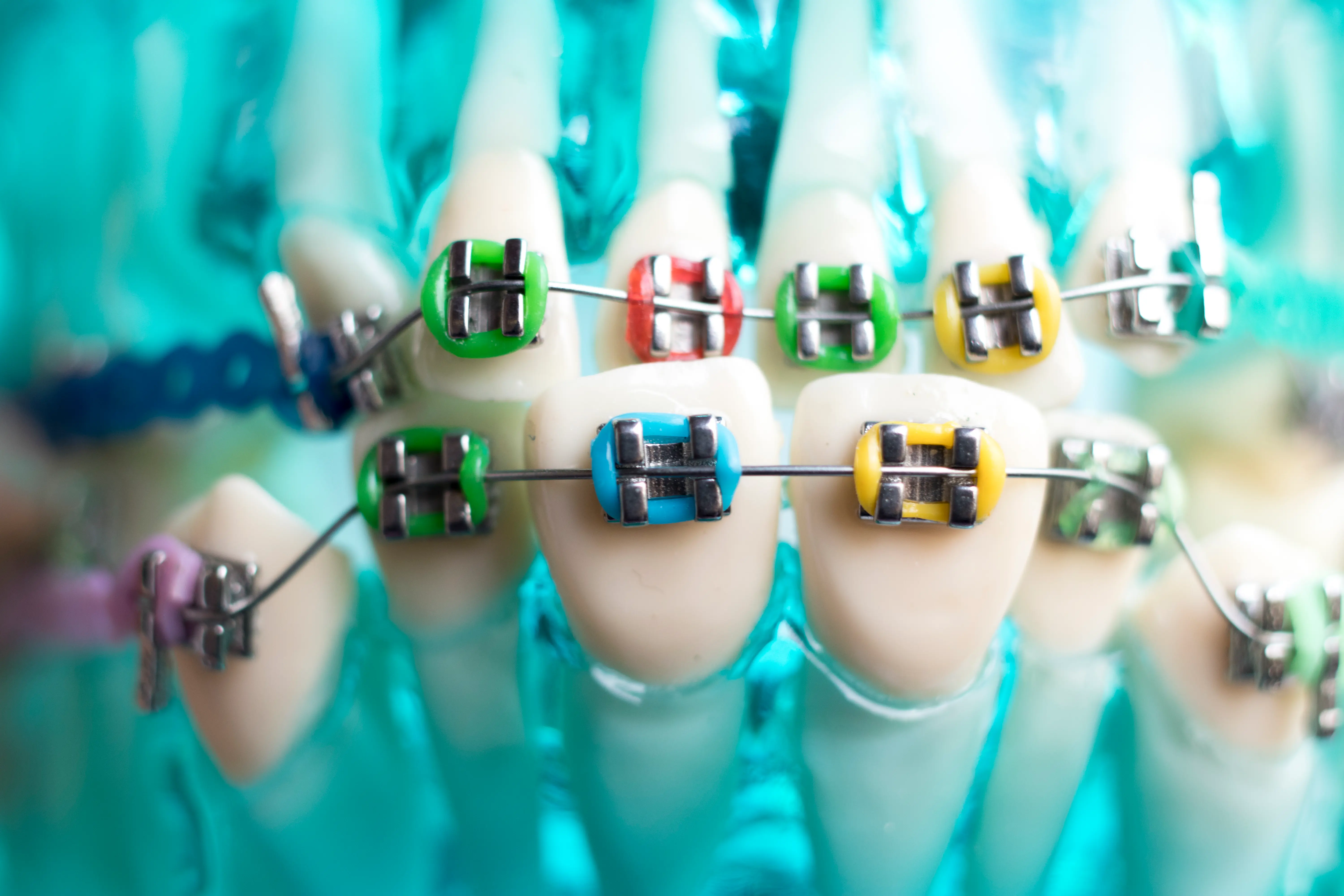 Metal braces in Vizag — affordable orthodontic treatment at Ravi's Dental Care