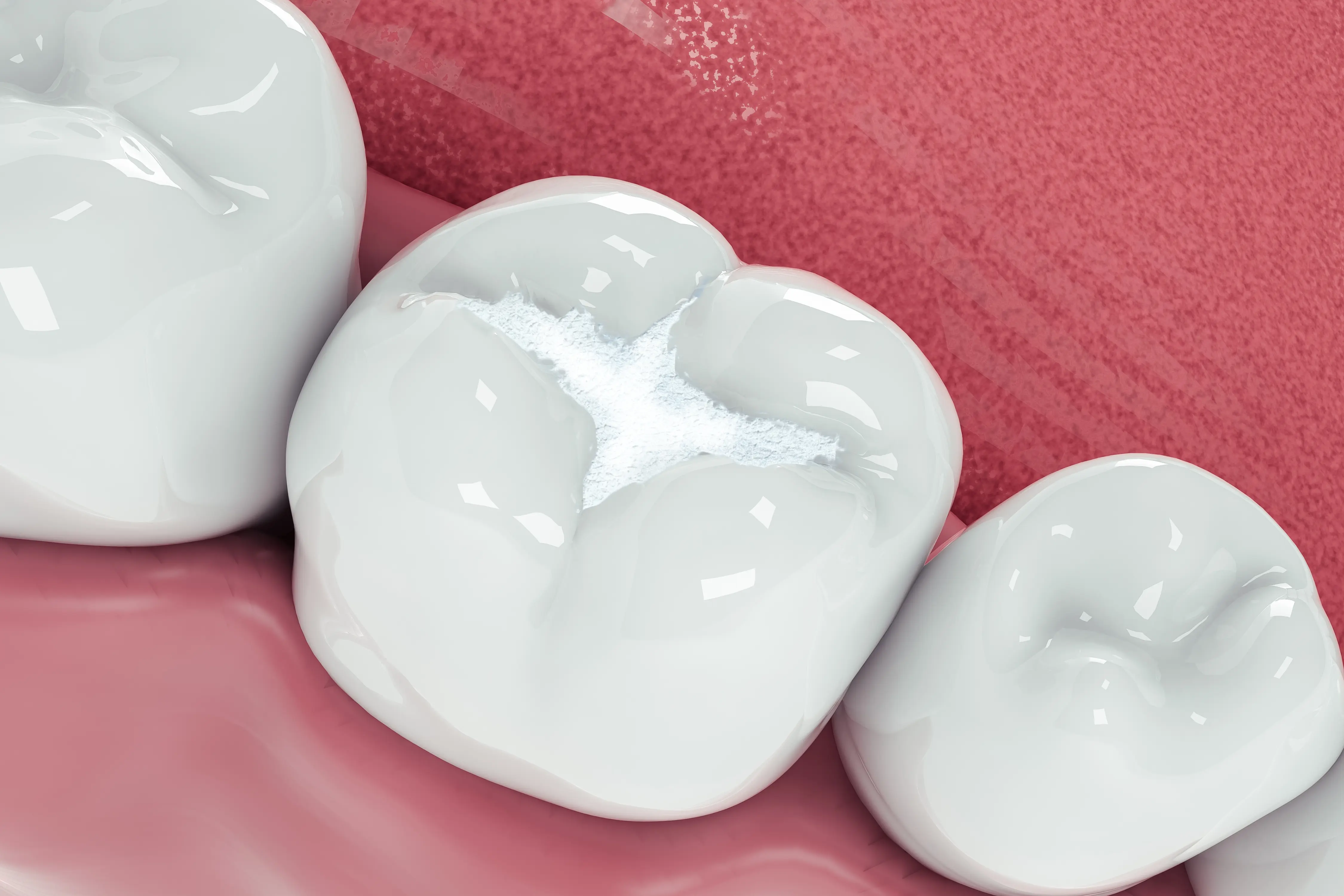 Front tooth composite bonding in Vizag — natural tooth-colored filling result