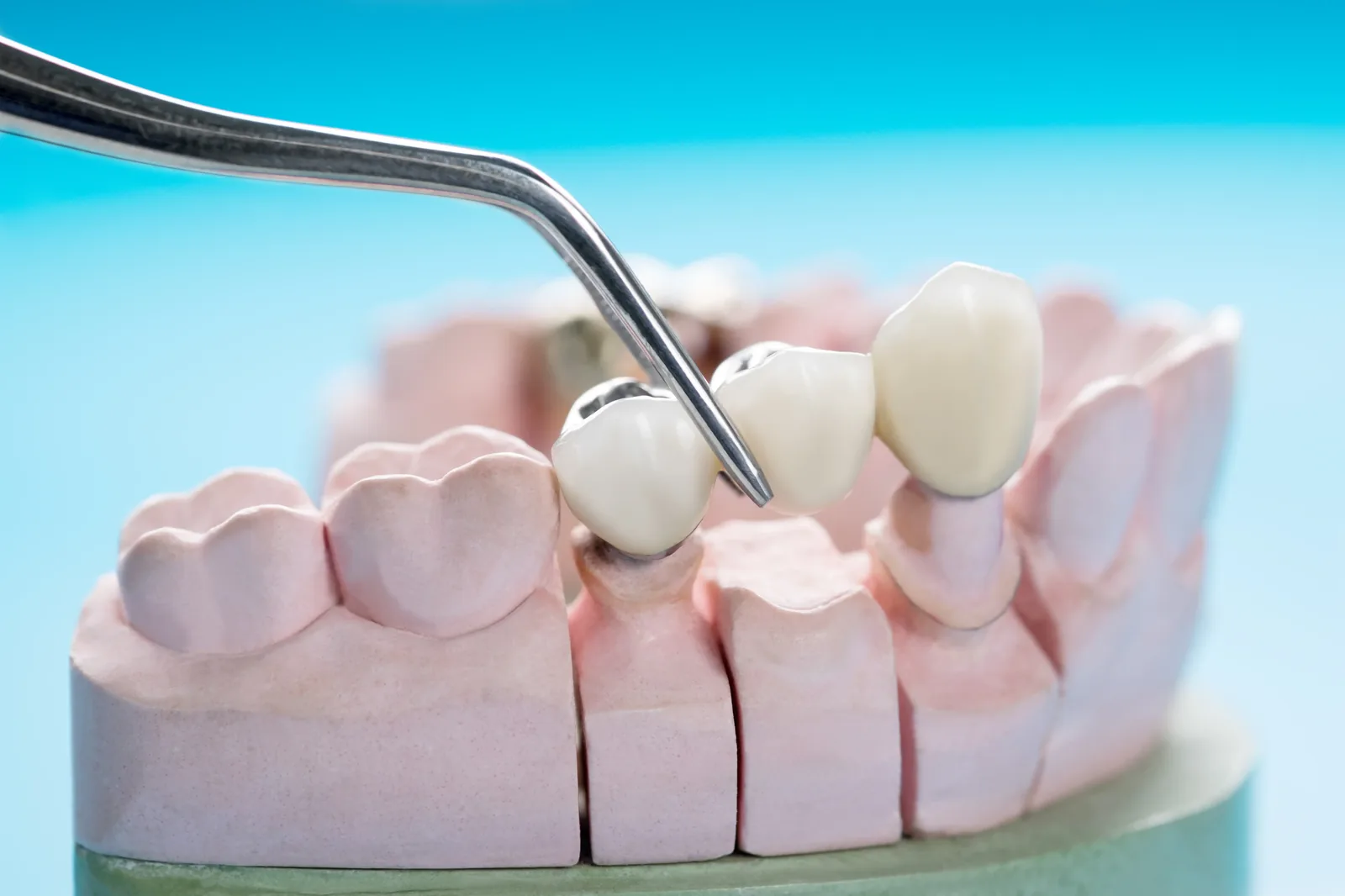 Prosthodontist fitting dentures for a patient at Ravi's Dental Care, MVP Colony, Vizag