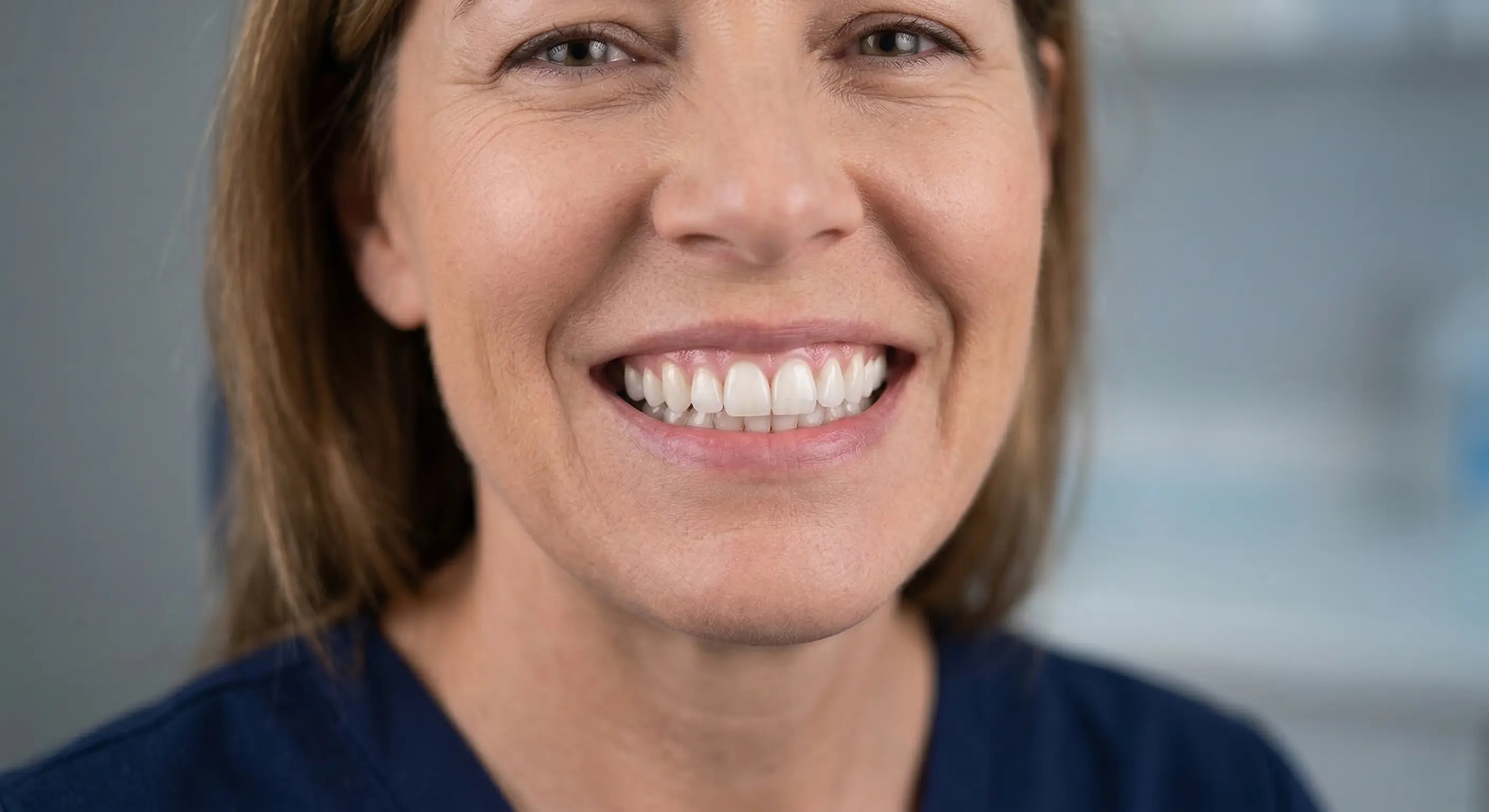 Full mouth All-on-4 dental implant smile result at Ravi's Dental Care, MVP Colony, Vizag