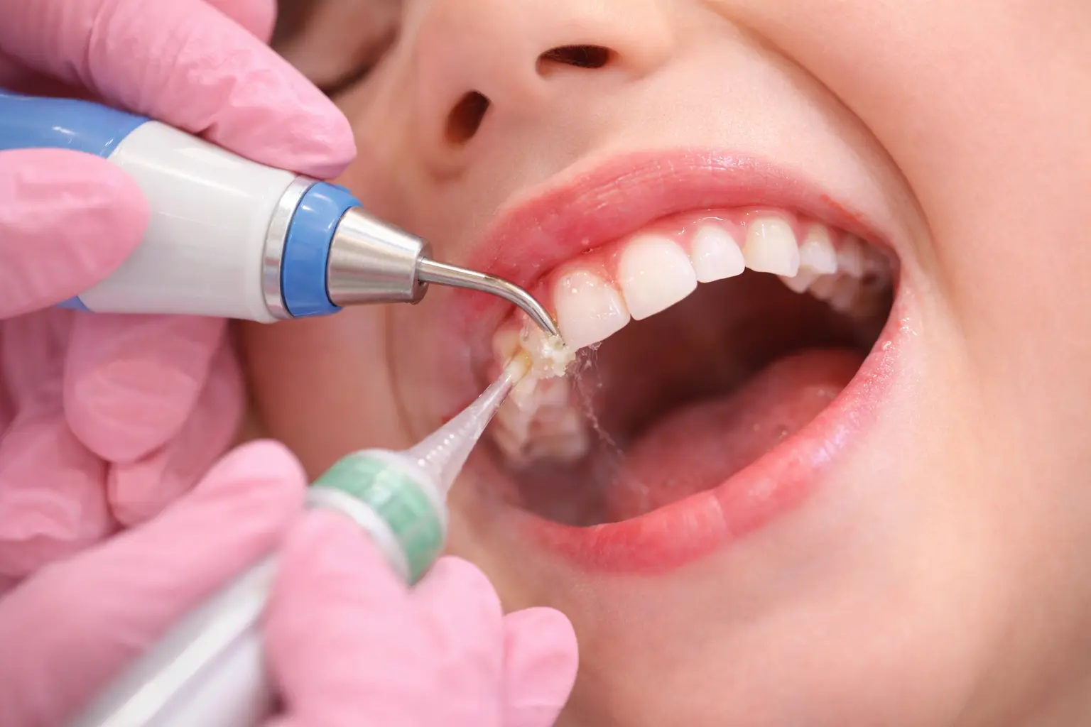 Expert gum disease treatment at Ravi's Dental Care MVP Colony Visakhapatnam