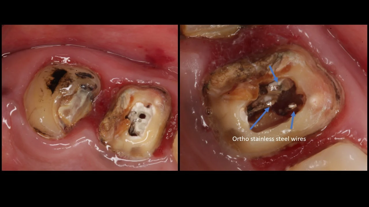 Failed root canal reopened under magnification at Ravi's Dental Care, Vizag &mdash; orthodontic stainless steel wires found left inside the canals