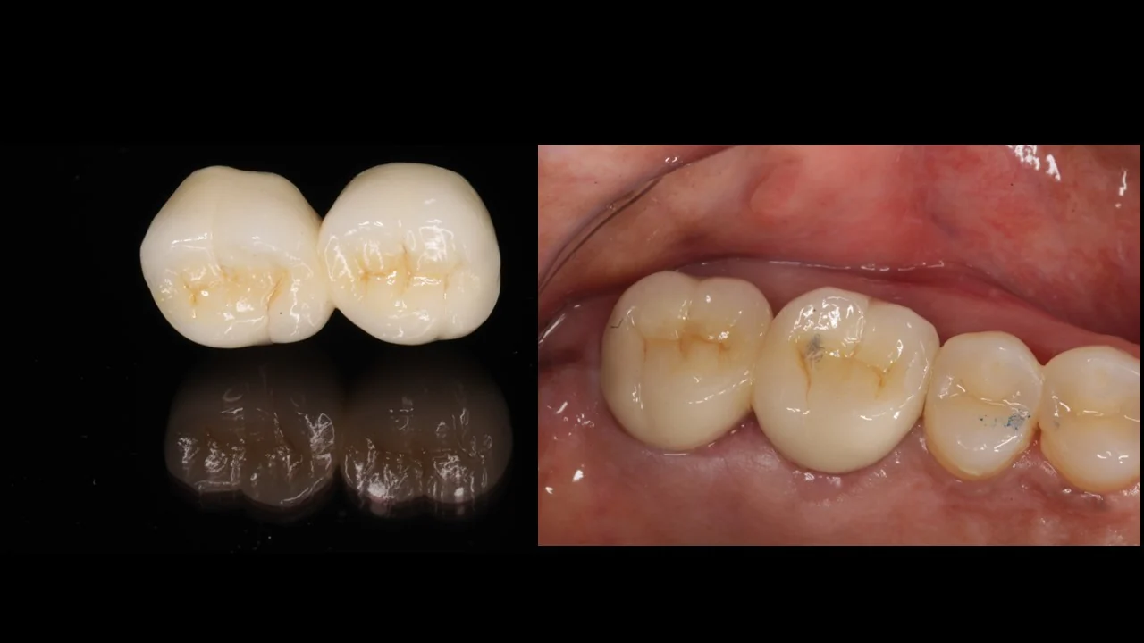 Re-root canal treatment result at Ravi's Dental Care, Vizag &mdash; ceramic crowns placed on two retreated molars