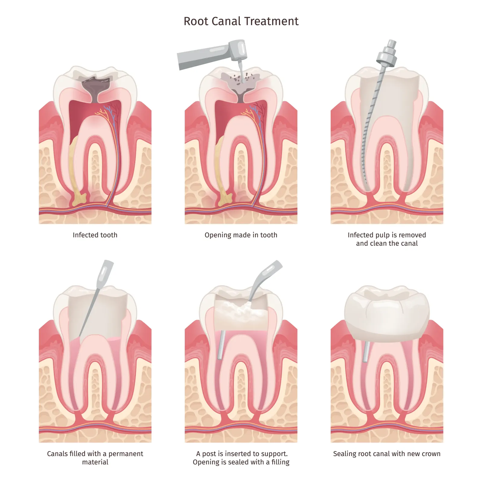 Root canal treatment procedure diagram — Ravi's Dental Care, Visakhapatnam
