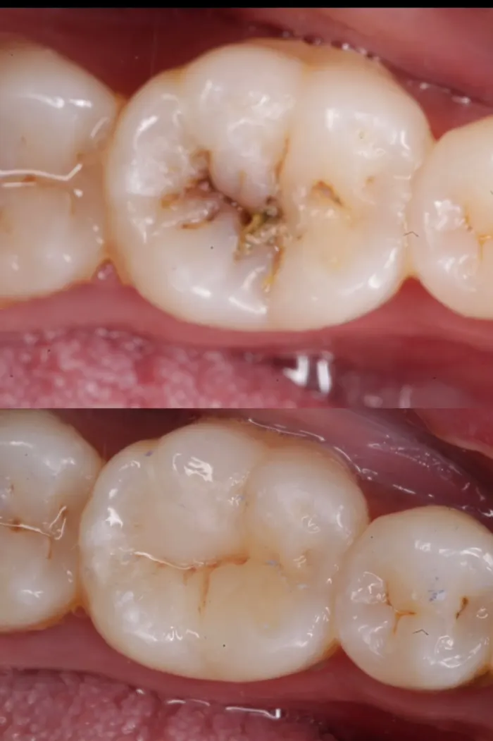 Clinical before and after photo of a decayed lower molar restored with a tooth-coloured filling