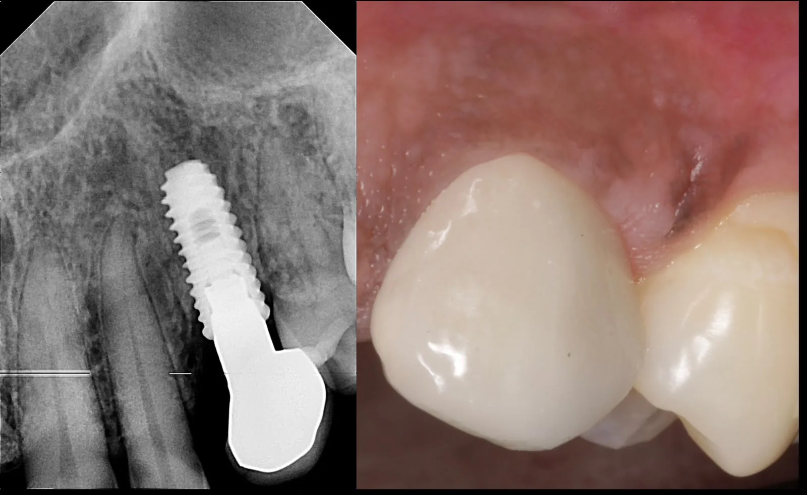 Dental implant on X-ray, showing the threaded post in the jawbone with its crown, beside a photo of the finished implant crown in the mouth