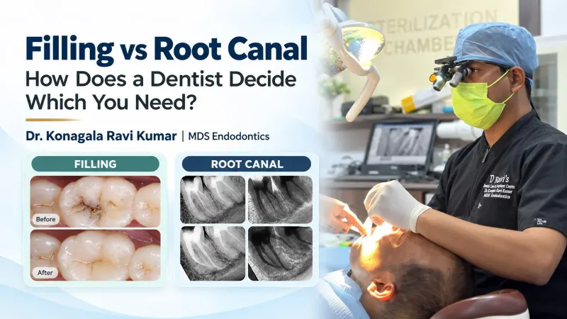 Do You Need a Filling or Root Canal? Signs, Tests and Treatment Choices