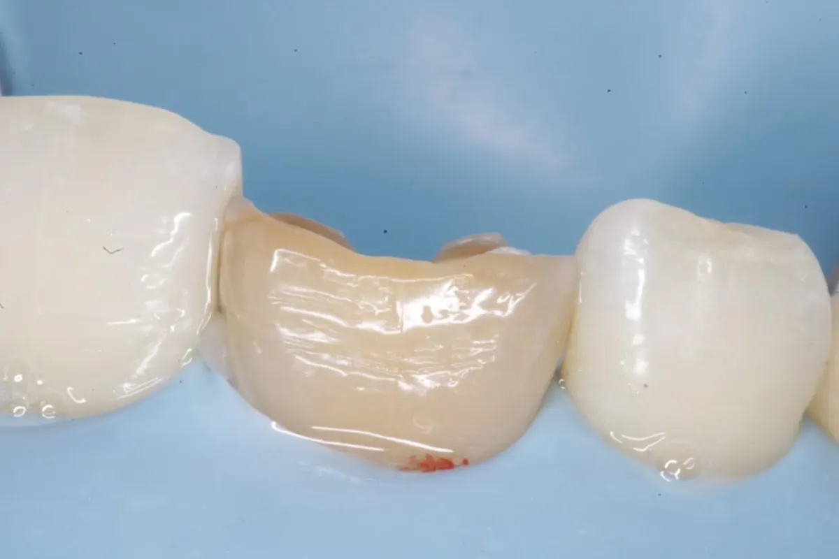 Close-up of a conservative access cavity prepared under magnification during root canal treatment in Vizag