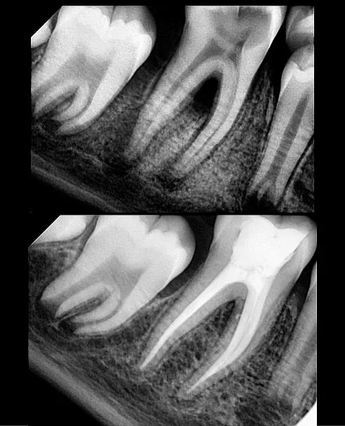 Before and after X-rays of a molar root canal treatment showing infection at the root and the completed three-dimensional canal filling
