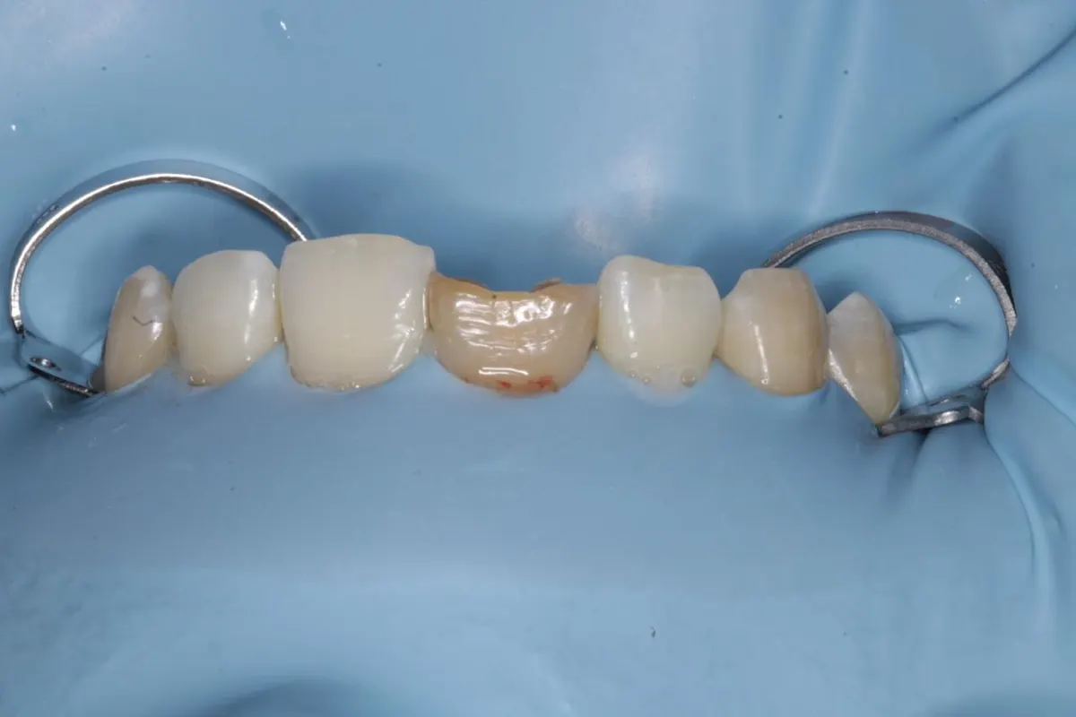 Rubber dam isolation with clamps in place before root canal treatment at Ravi’s Dental Care, Vizag