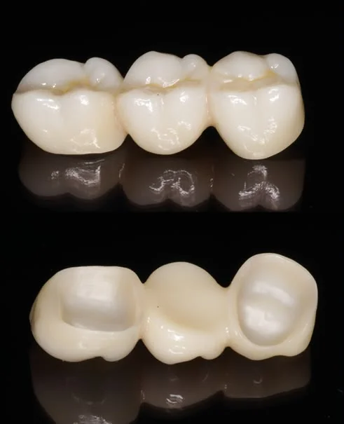 Three-unit dental bridge: chewing surface on top, and underneath the two hollow crowns that fit over the supporting teeth with the pontic between them