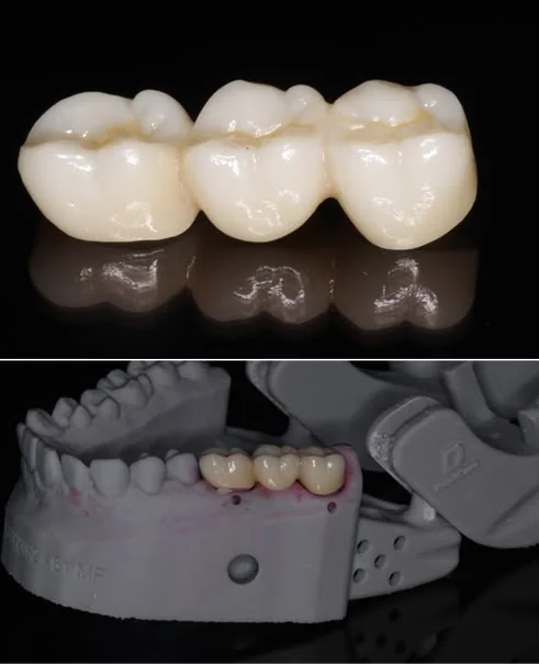 Three-unit tooth-coloured dental bridge, and the same bridge checked on a model of the patient's jaw before it is fitted